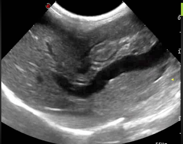 Formation EAN1 : Echographie abdominale normale : Partie 1 - foie, rate, reins, vessie, appareil génital.