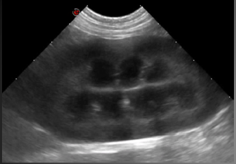 Formation EAN1 : Echographie abdominale normale : Partie 1 - foie, rate, reins, vessie, appareil génital.
