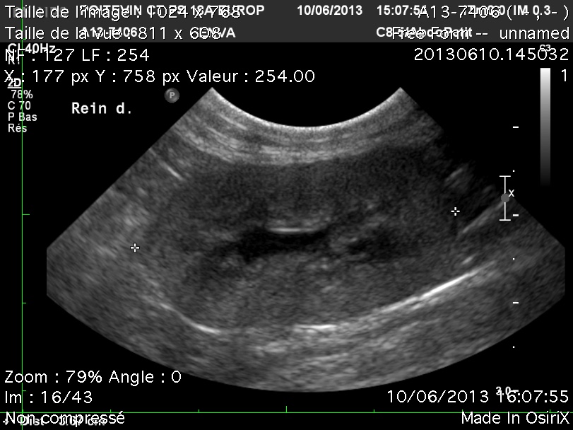 Formation EAP2-LIVE : Echographie abdominale pathologique: Appareil urinaire et génital