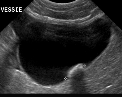 Formation EAP2 : Echographie abdominale pathologique - appareil urinaire, appareil génital