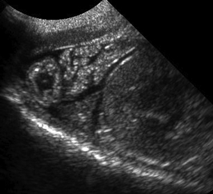 Formation EAP3-LIVE : Echographie abdominale pathologique: Tube digestif, pancréas et surrénales