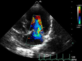 Formation EC002 : Echographie Doppler cardiaque - aspect normal