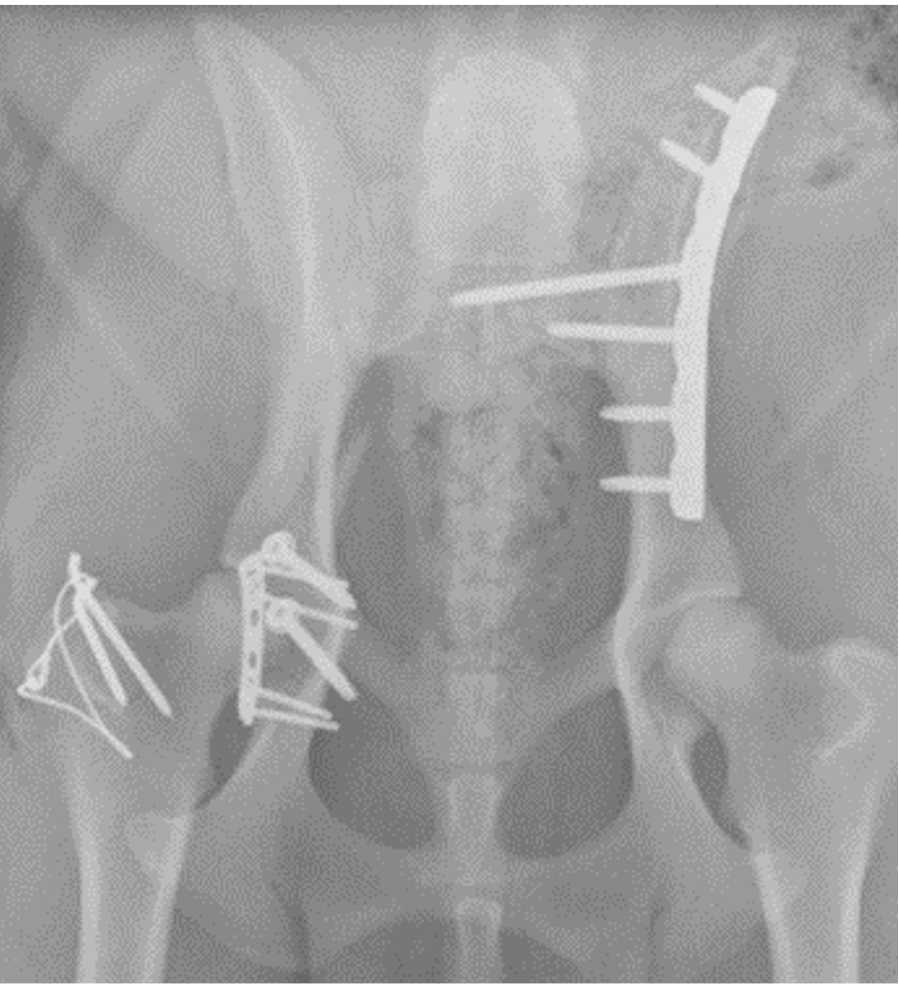Formation CHIR6B : Chirurgie du bassin : quand et comment traiter les fractures pelviennes ?