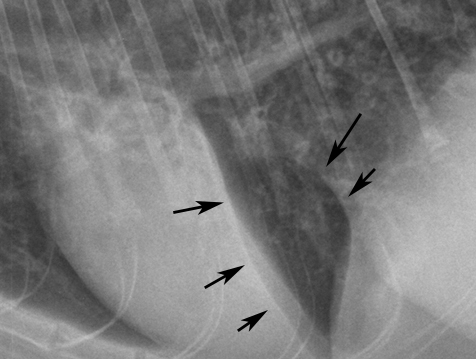 Formation RXNT2 : Radiographie thoracique: Le thorax, partie 2 : lésions pulmonaires